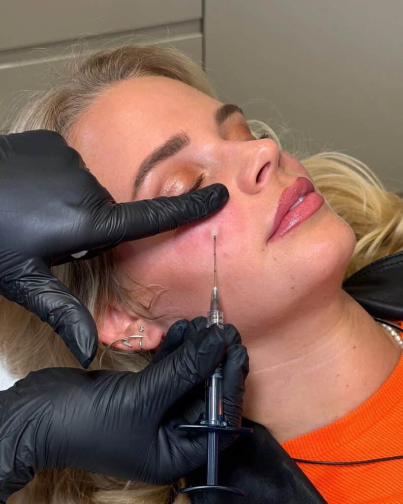 dermal filler procedure 6