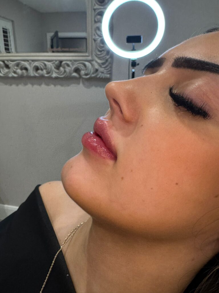 filler lip 2