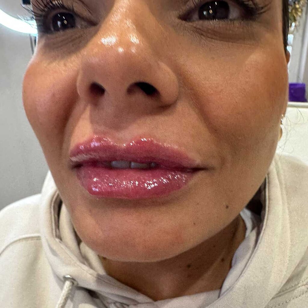 lip filler after